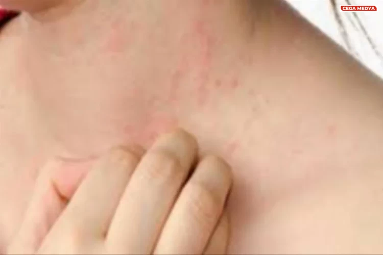 Dermatoloji Uzmani Acikladi Uyuz Hastaliginin Belirtileri Nelerdir 1699259155 257 X750