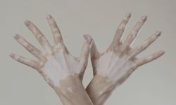 Vitiligo hakkında bilinen yanlışlar