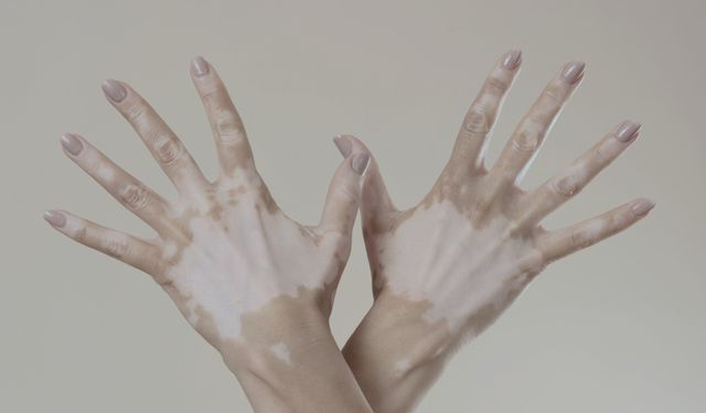 Vitiligo hakkında bilinen yanlışlar