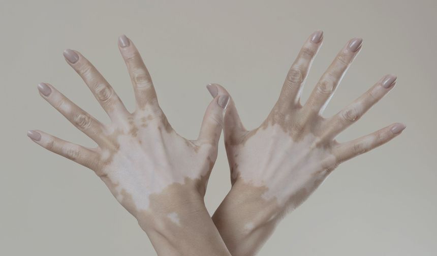 Vitiligo hakkında bilinen yanlışlar